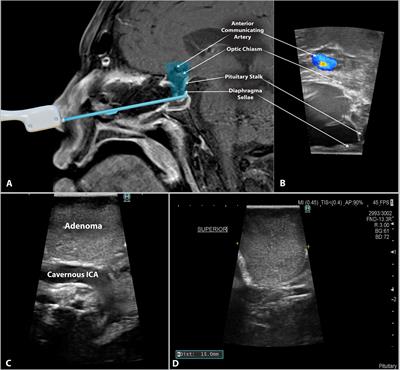 Side-firing intraoperative ultrasound applied to resection of pituitary macroadenomas and giant adenomas: A single-center retrospective case-control study